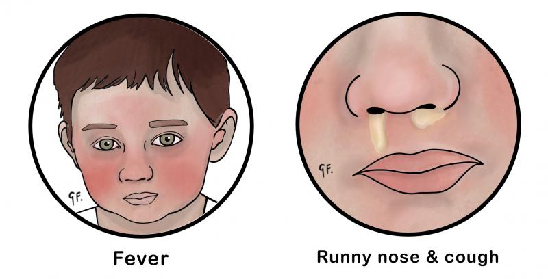 Illustration of the symptoms of chickenpox 