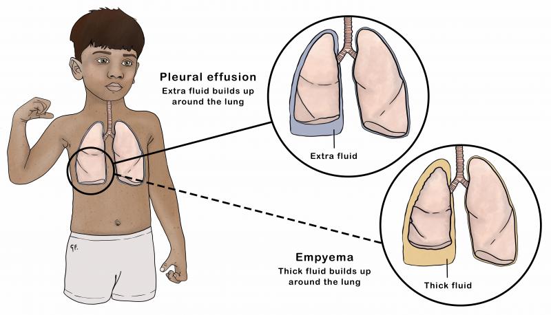 Illustration of a child with insets highlighting a pleural effusion compared with an empyema