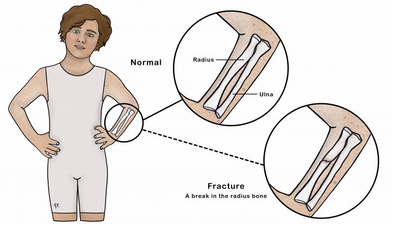 Illustration showing a child with normal arm bones compares with a fractured arm bone