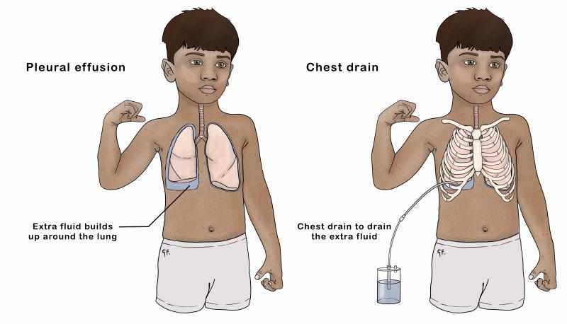 Illustration of a child with a pleural effusion next to an illustration showing a chest drain for the pleural effusion