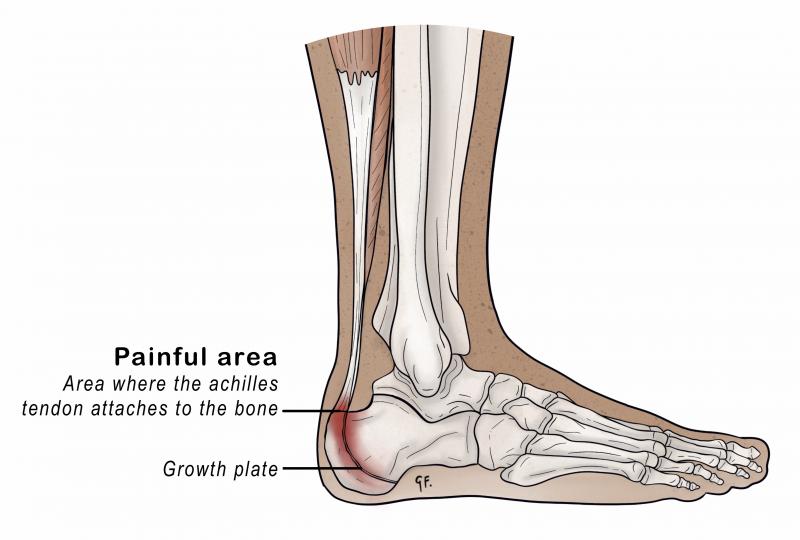 Illustration showing the painful area in sever's disease 