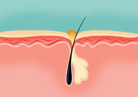 A diagram showing a blackhead