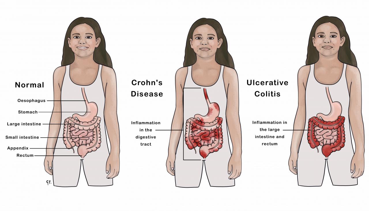 Image showing child with normal gastrointestinal tract compared with ulcerative colitis and Crohn's disease