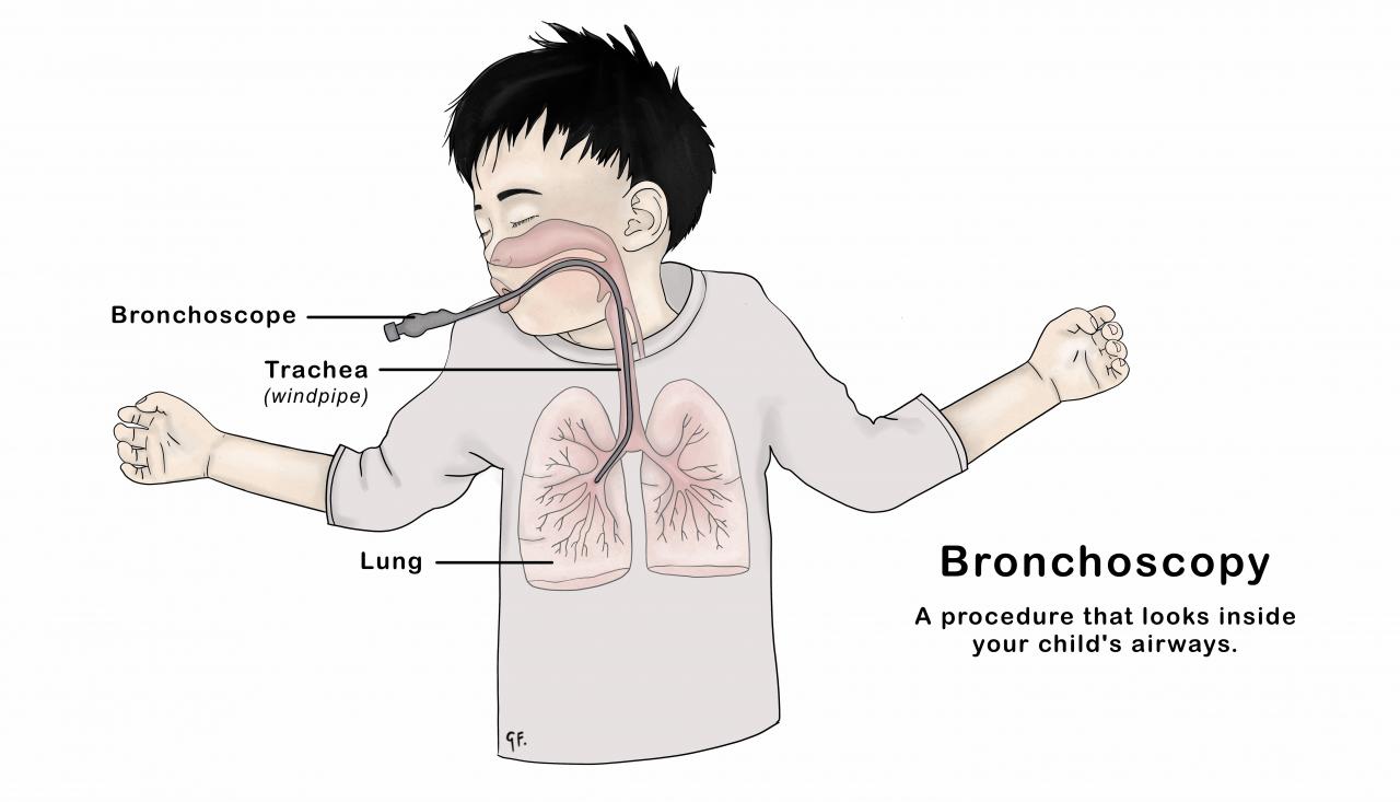 Illustration showing a child asleep having a flexible bronchoscopy procedure 