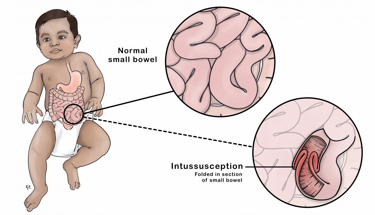 ILmage of a child showing a normal bowel and intussusception 