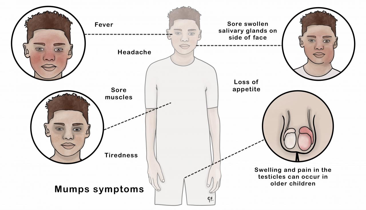 illustrations showing symptoms of mumps in young people